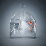 Five things governments can do to turn the tide on lung cancer