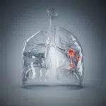 Five things governments can do to turn the tide on lung cancer