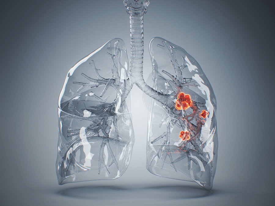 Five things governments can do to turn the tide on lung cancer