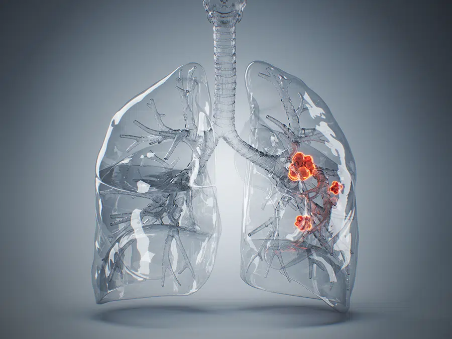 Five things governments can do to turn the tide on lung cancer